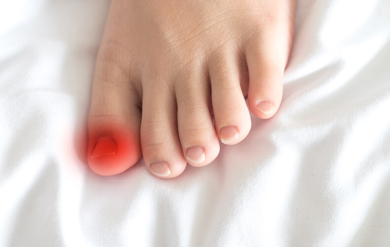 Лечение грибка ногтей